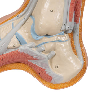 Squelette d'un pied creux (Pes Cavus) - 3B Scientific